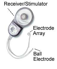 Impianto cocleare Parte impiantabile